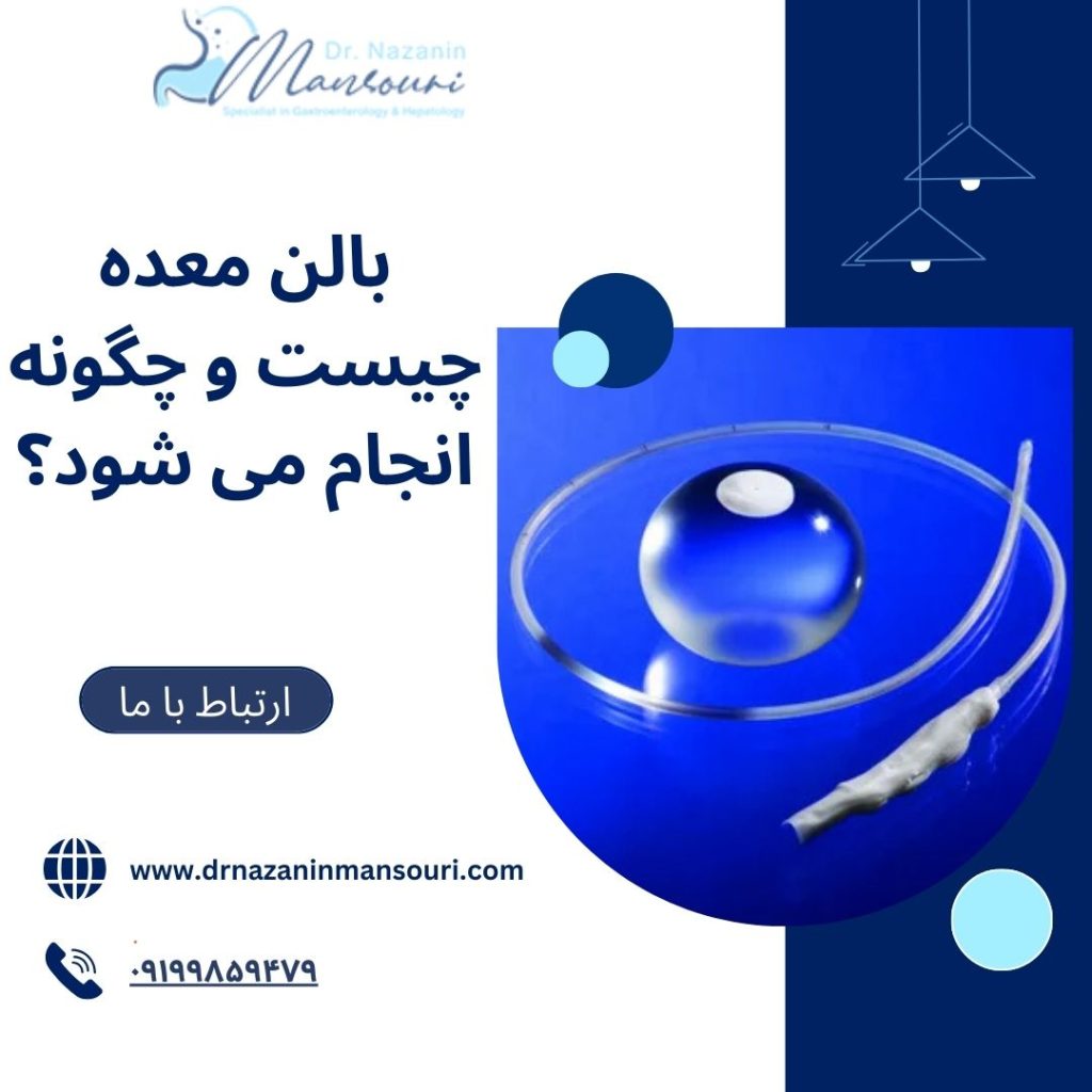 بالن معده