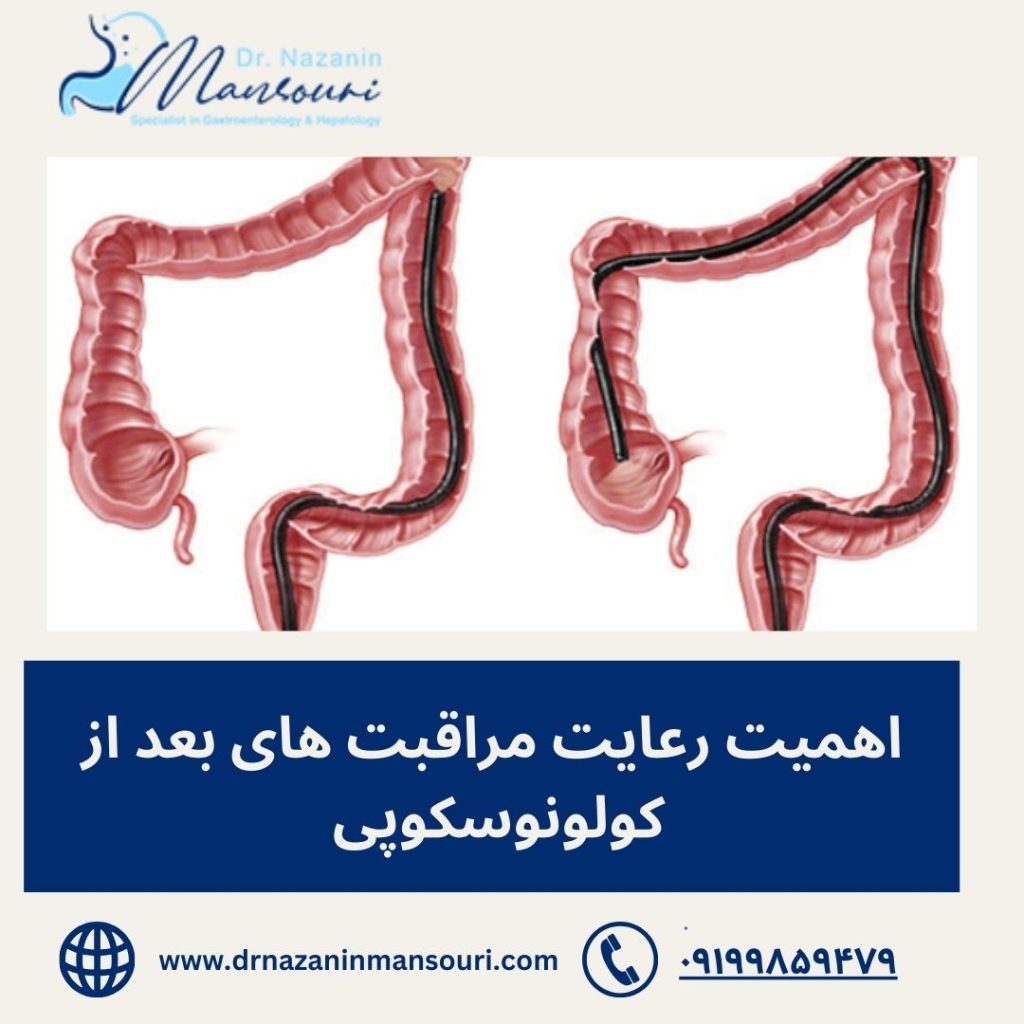 مراقبت های بعد از کولونوسکوپی