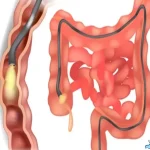 رژیم غذایی بعد از کولونوسکوپی