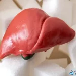 کبد چرب گرید 2