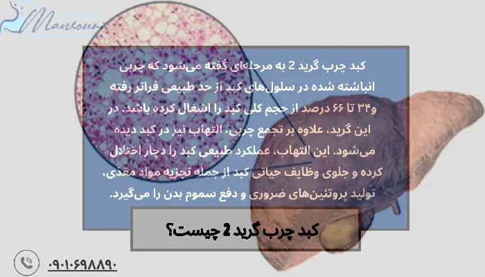 کبد چرب گرید 2