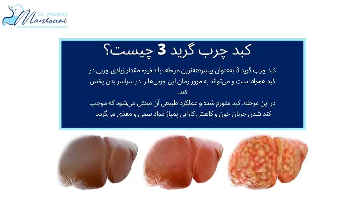 کبد چرب گرید 3