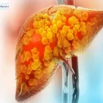 علائم کبد چرب روی پوست