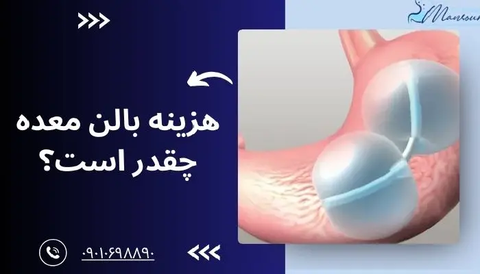هزینه بالن معده