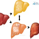 تفاوت کبد چرب الکلی و غیرالکلی