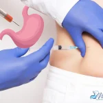 آیا بوتاکس معده برگشت دارد؟