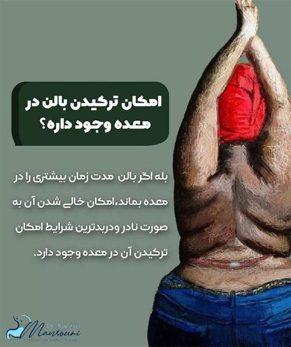 علائم ترکیدن بالن معده