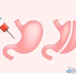 بوتاکس معده بهتر است یت اسلیو