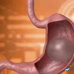 ترکیدن بالن معده