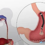 سوالات متداول بوتاکس معده