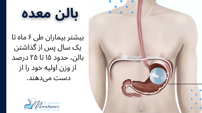 بالن معده