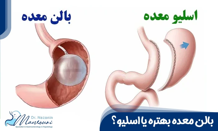 بالن معده بهتره یا اسلیو؟