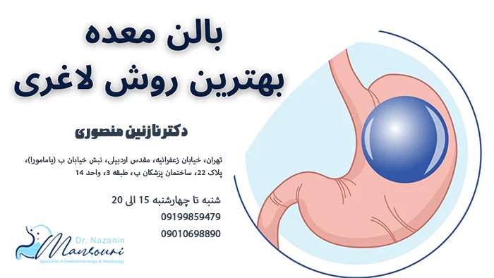 بالن معده بهترین روش لاغری